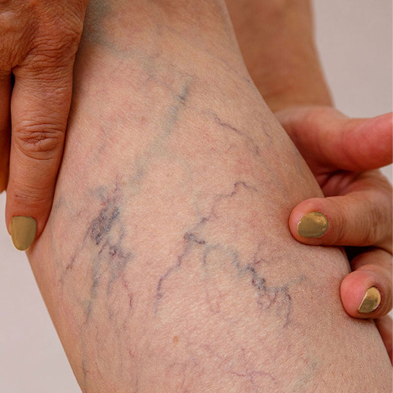 clinique vena. échographie veineuse soins varices, traitements carices, veines, laser